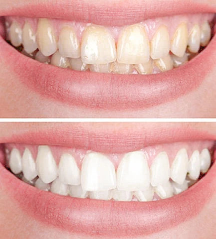 White Teeth Whitener (50% OFF)