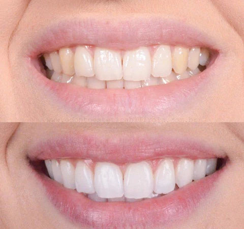 White Teeth Whitener (50% OFF)